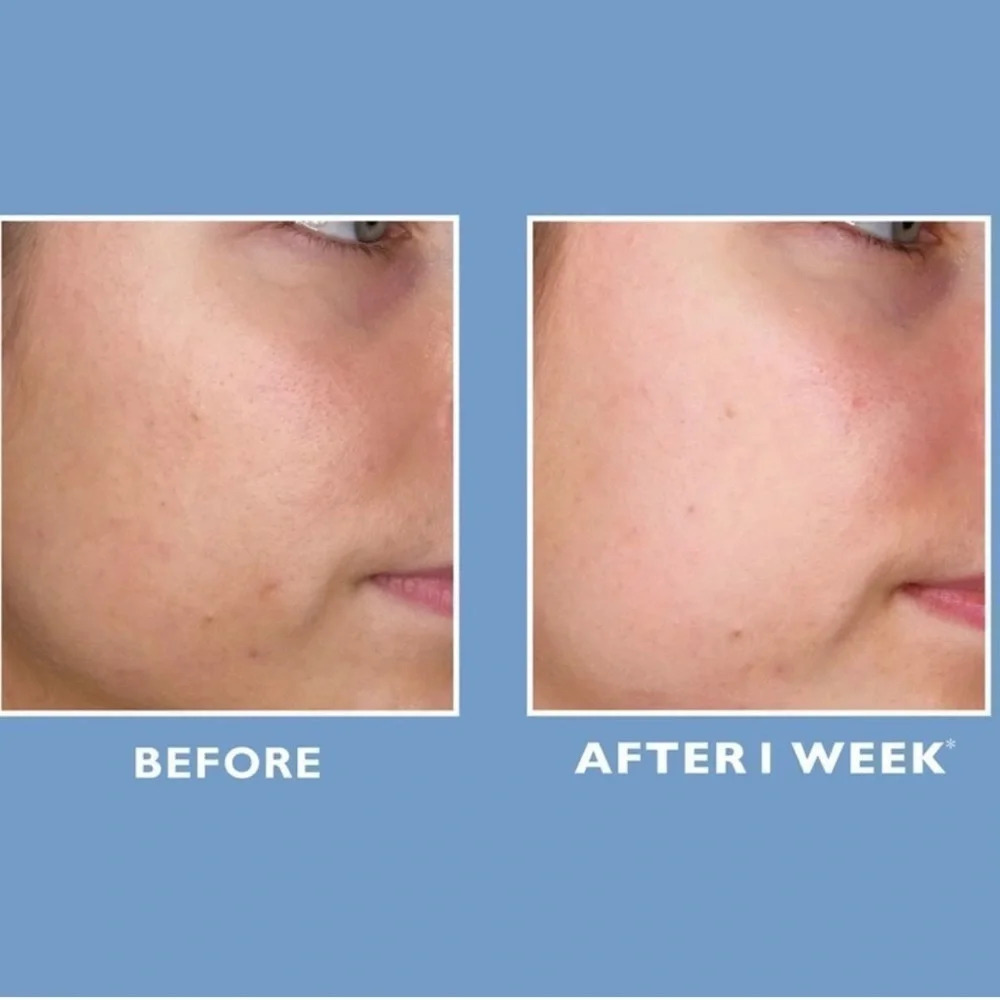 ONLY 1! Peter Thomas Roth ProStrength 10% PHA Exfoliating Clarifying Liquid - Picture 5 of 7